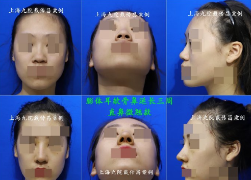 戴傳昌鼻子案例