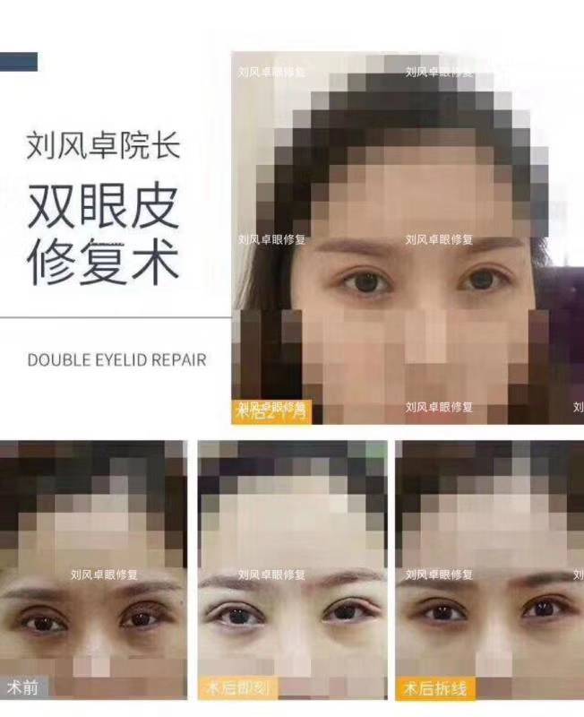 劉風卓雙眼皮修復案例