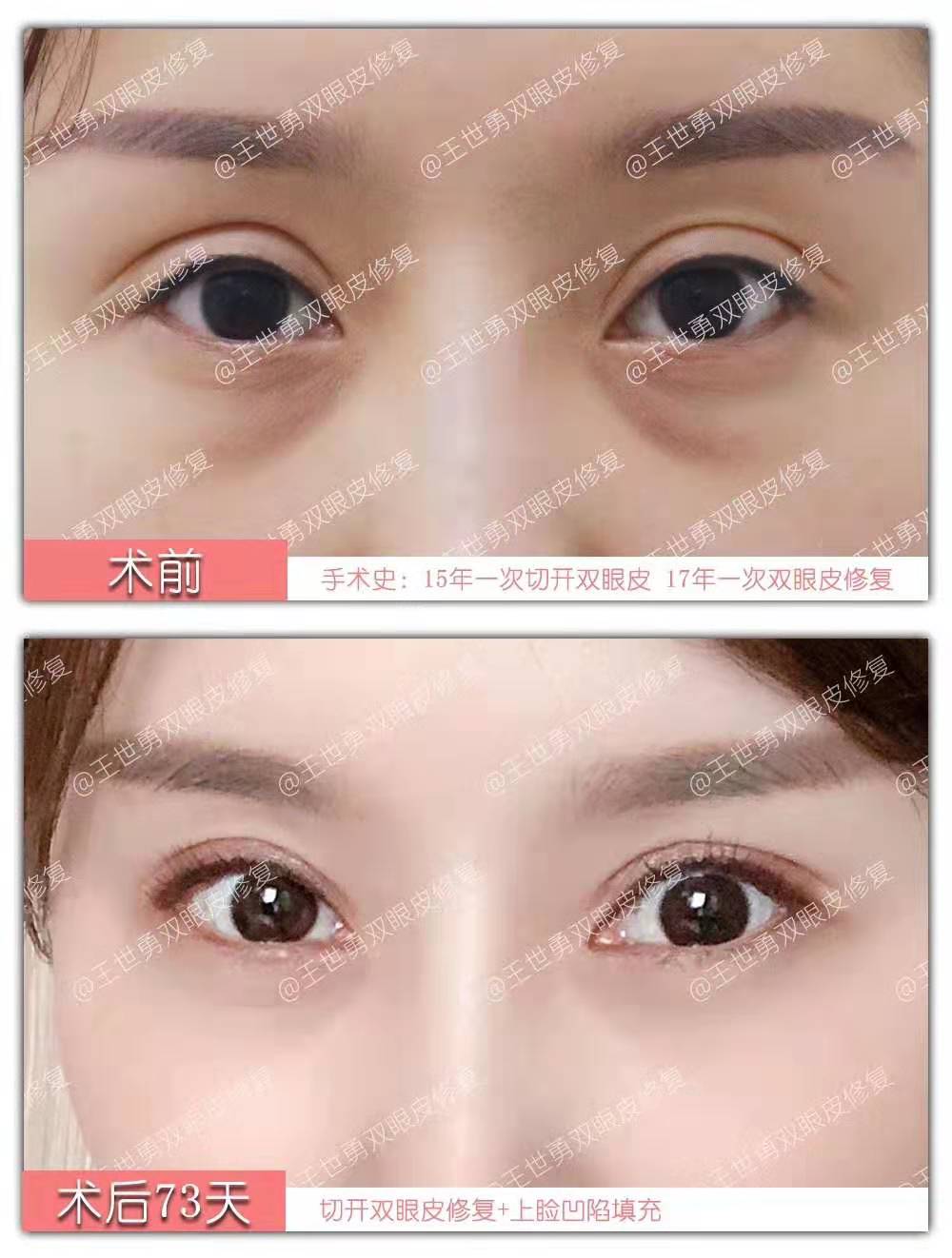 王世勇雙眼皮修復案例