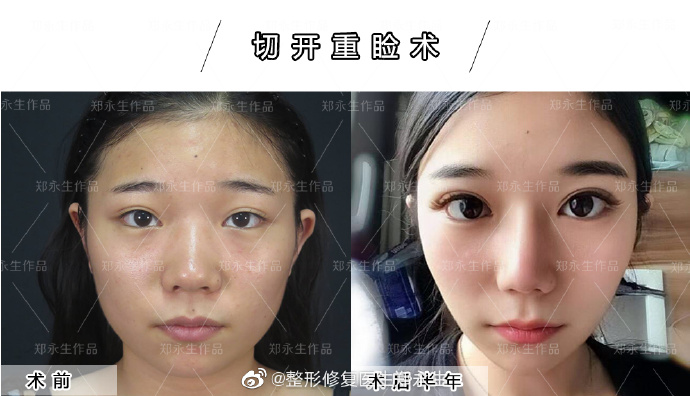 鄭永生雙眼皮修復案例