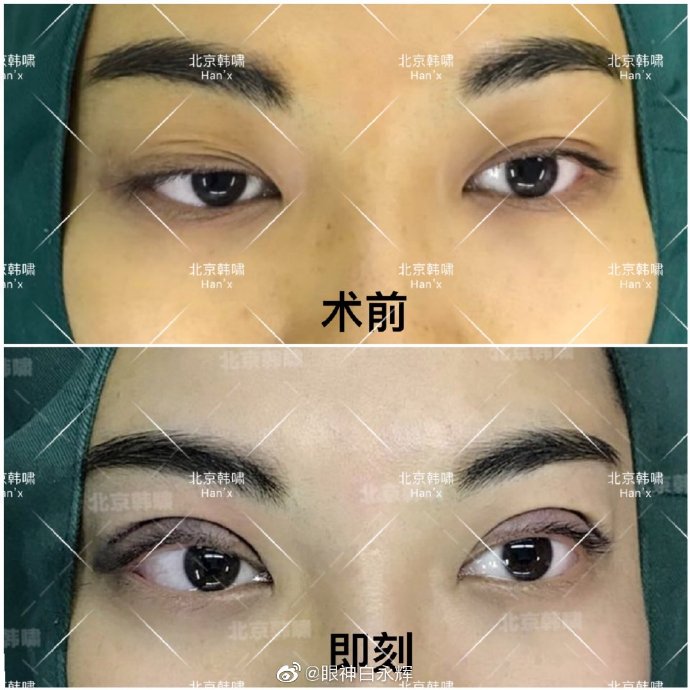 白永輝雙眼皮修復案例
