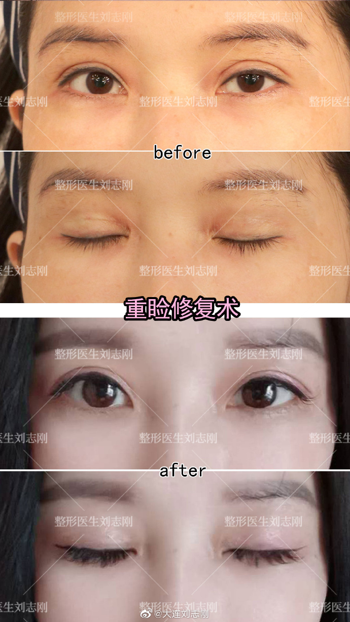 劉志剛雙眼皮修復案例