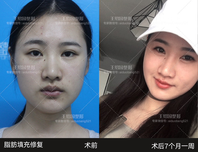王紹國脂肪修復案例