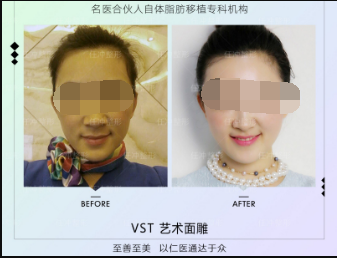 任沖脂肪修復案例