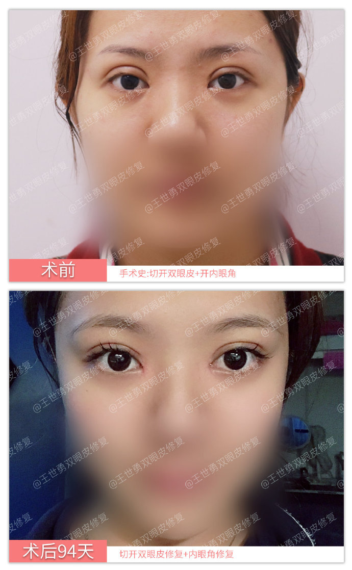 王世勇雙眼皮修復案例