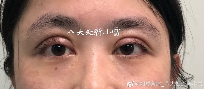 靳小雷雙眼皮修復案例