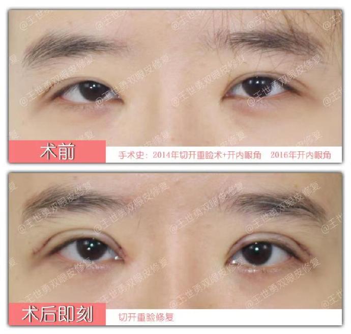 王世勇雙眼皮修復(fù)案例