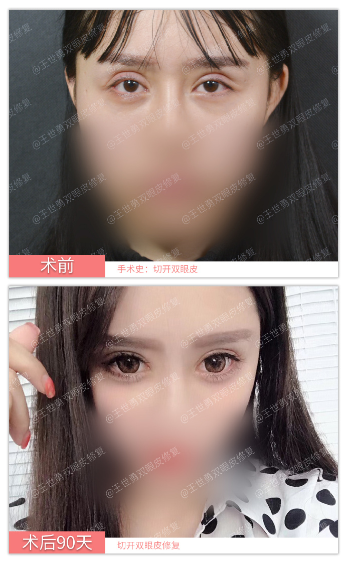 王世勇雙眼皮修復(fù)案例