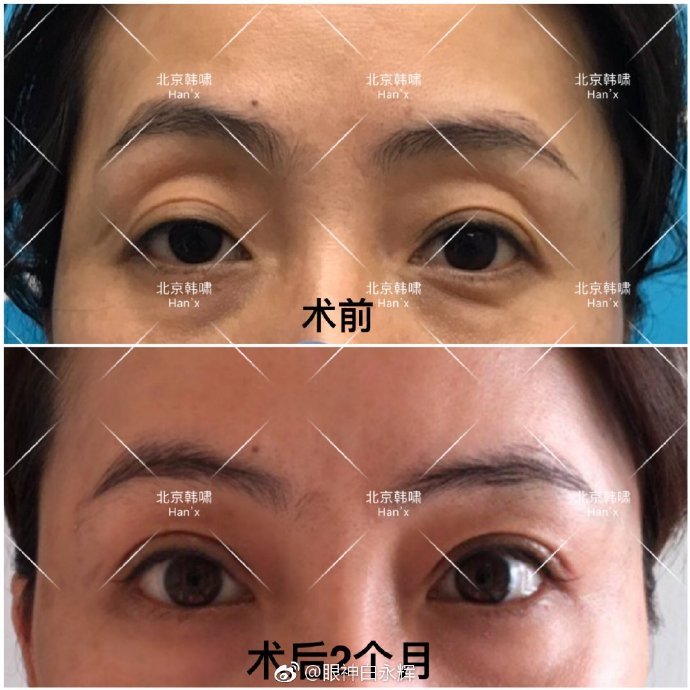 白永輝雙眼皮修復(fù)案例