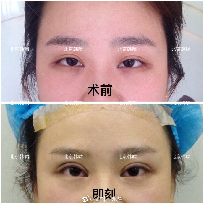 白永輝雙眼皮修復(fù)案例