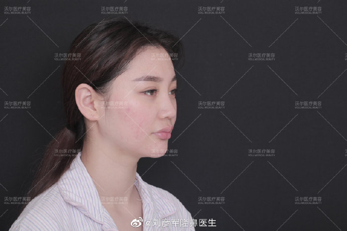 劉彥軍鼻修復(fù)案例