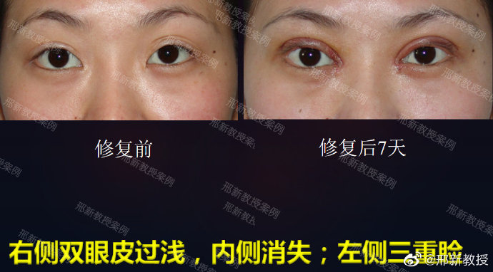 邢新雙眼皮修復案例