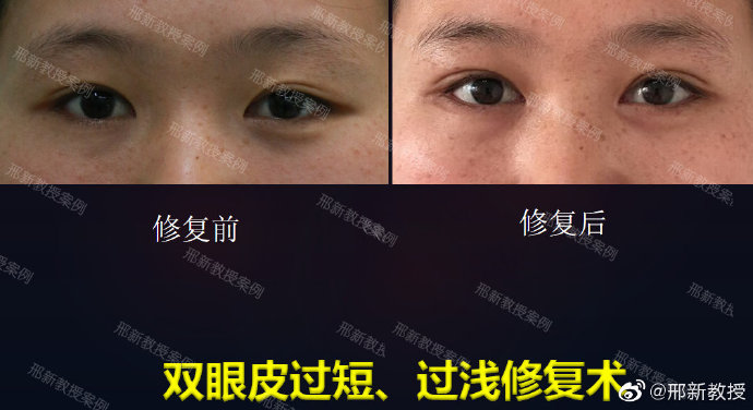 邢新雙眼皮修復案例