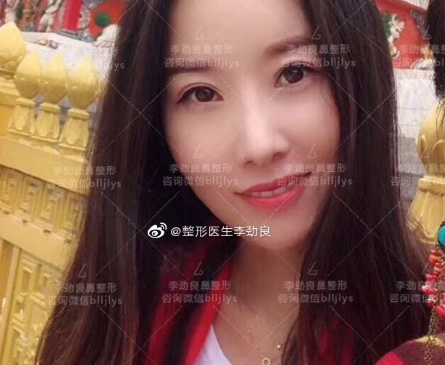 李勁良鼻綜合案例