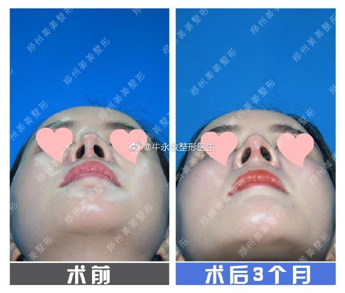 牛永敢鼻修復案例