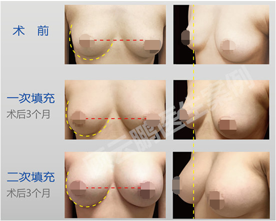 顧云鵬脂肪豐胸案例