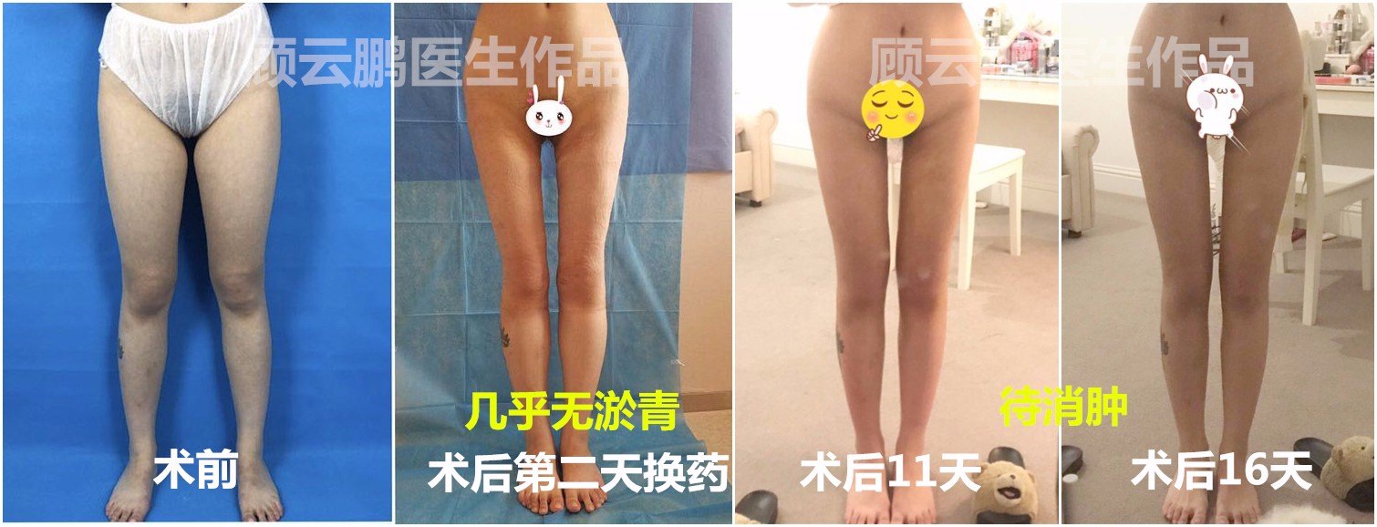 顧云鵬大腿吸脂案例