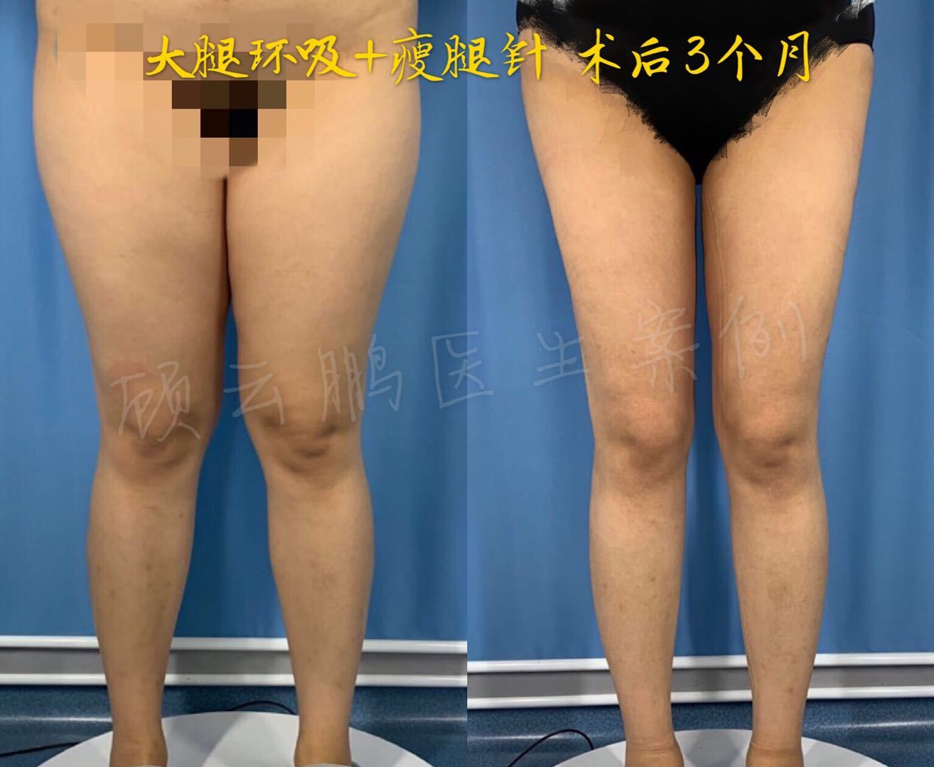 顧云鵬大腿吸脂案例