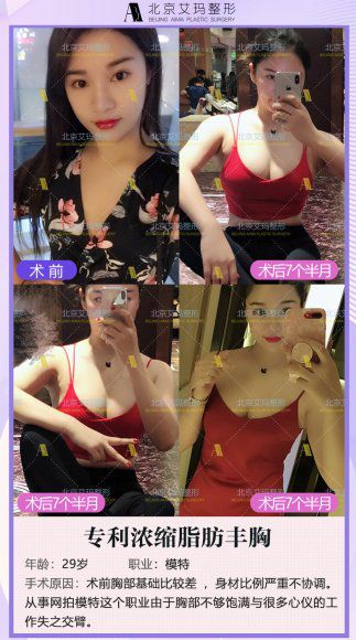 韋元強(qiáng)濃縮脂肪豐胸案例