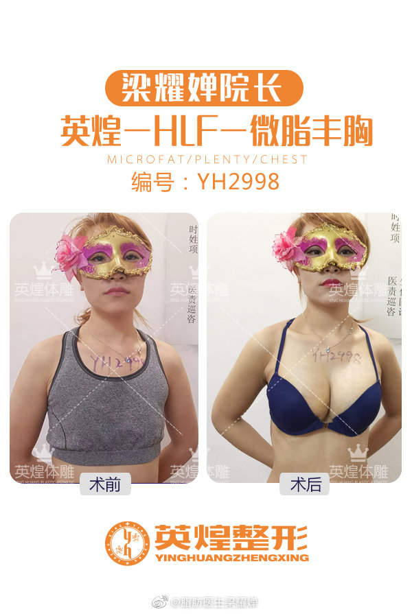 梁耀嬋脂肪豐胸案例