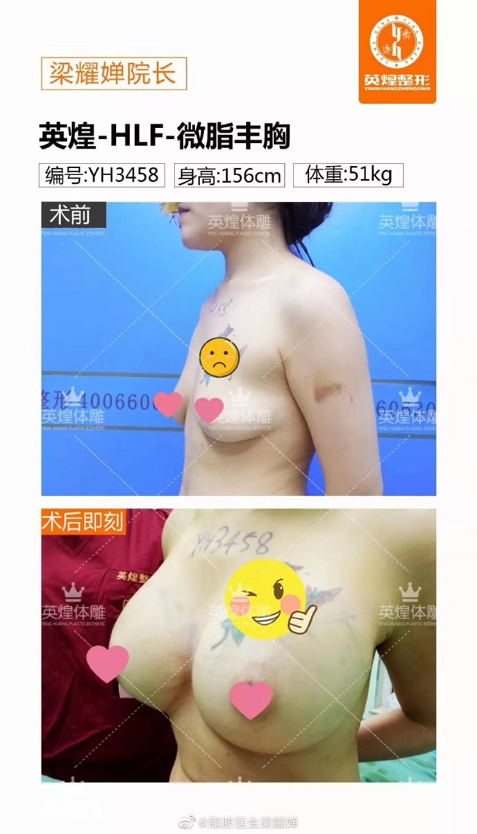 梁耀嬋脂肪豐胸案例