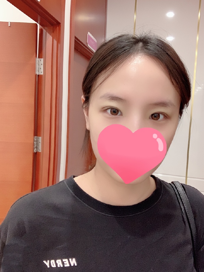 靳小雷、王世勇和韓勛哪個雙眼皮修復好？