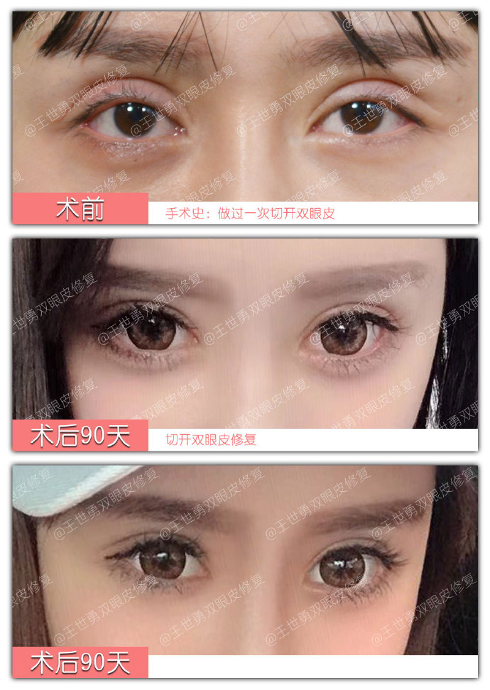 王世勇雙眼皮修復(fù)案例