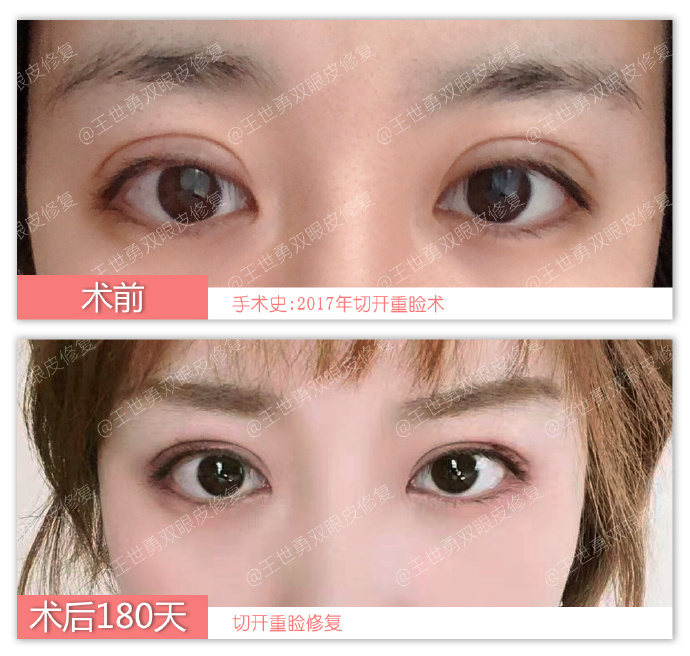 王世勇雙眼皮修復(fù)案例