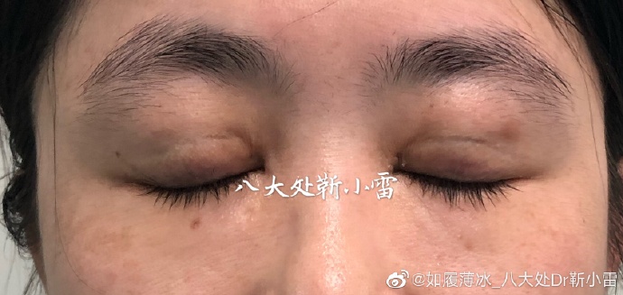 靳小雷雙眼皮修復(fù)案例