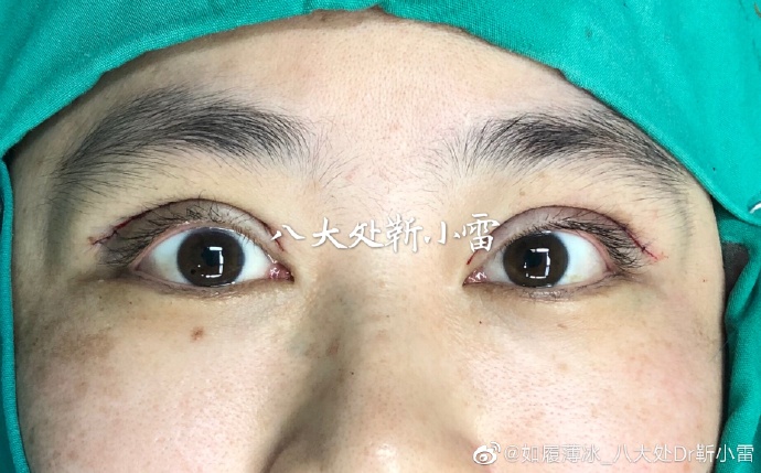 靳小雷雙眼皮修復(fù)案例