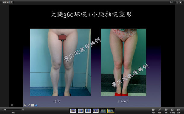 曹衛剛大腿環吸案例