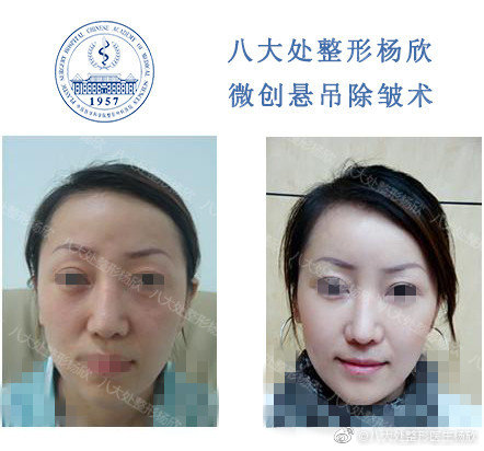 楊欣面部提升案例