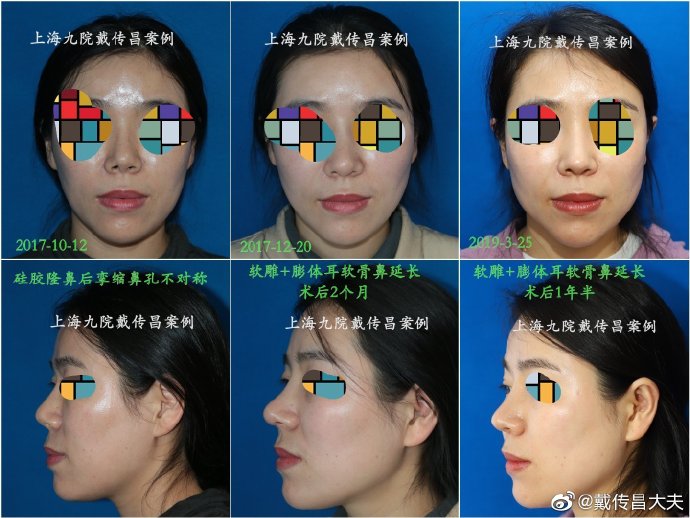 戴傳昌鼻整形案例