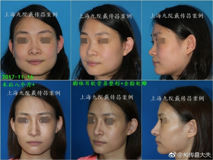 戴傳昌鼻修復案例