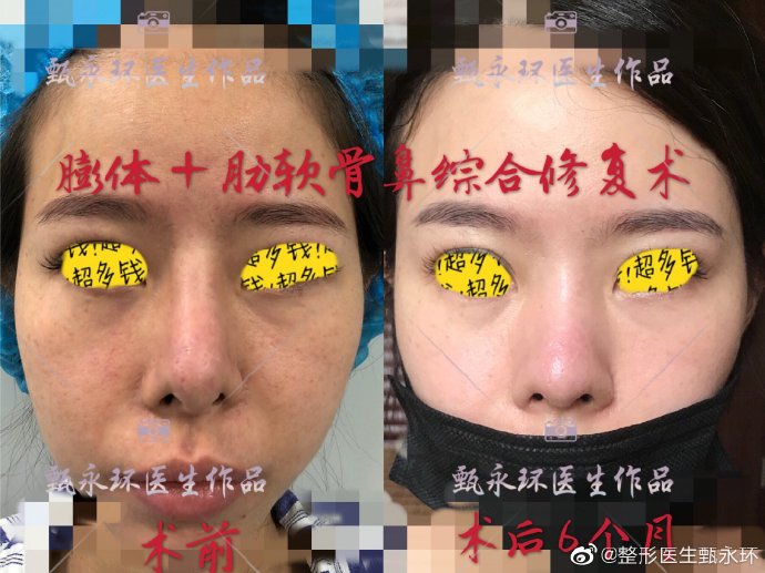 甄永環(huán)鼻綜合案例