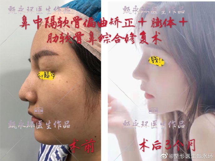 甄永環(huán)鼻綜合案例