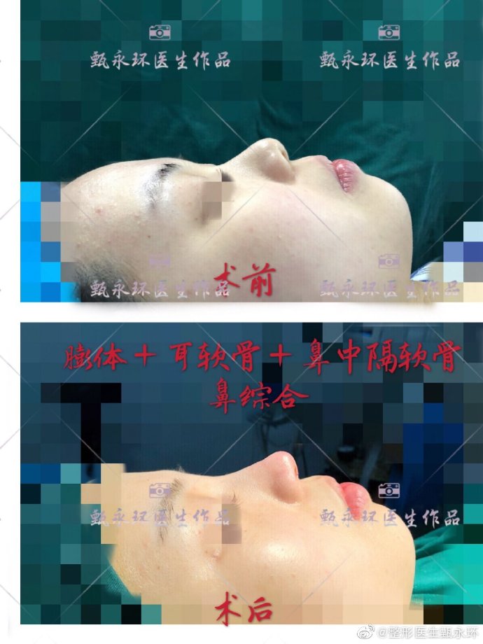 甄永環(huán)鼻綜合案例