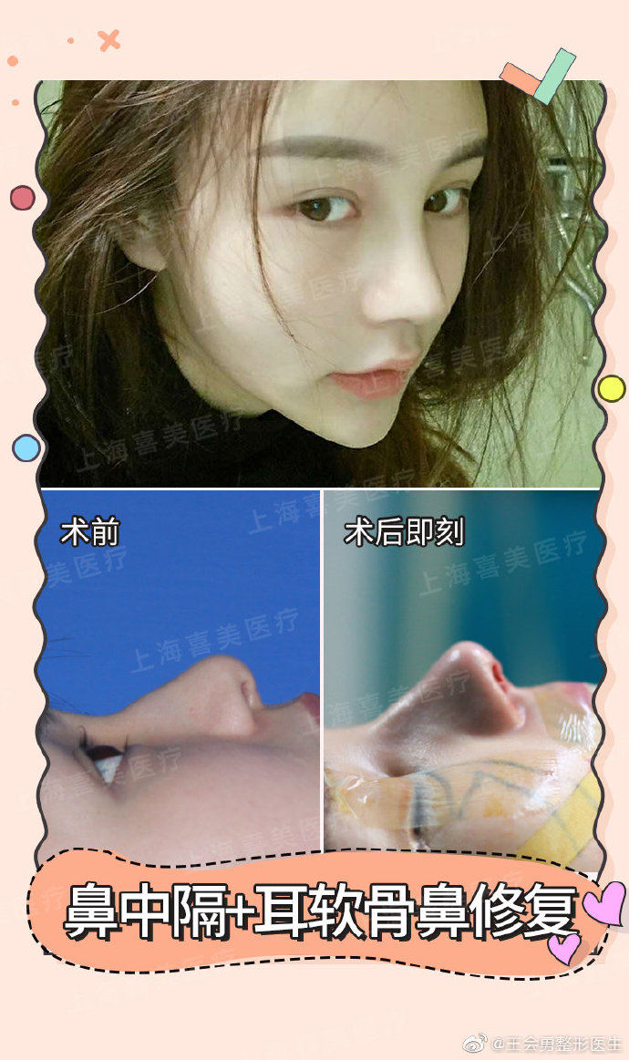 王會勇鼻修復(fù)案例