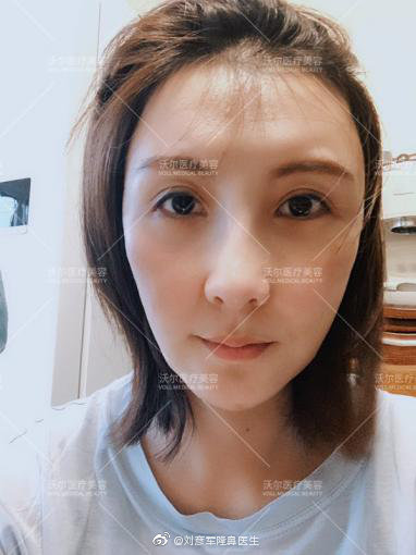 劉彥軍鼻修復(fù)案例