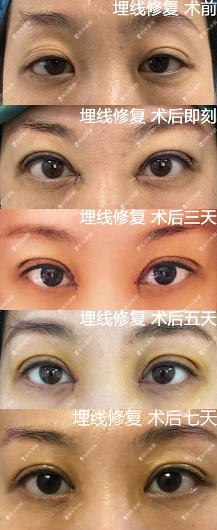 田國靜雙眼皮修復案例