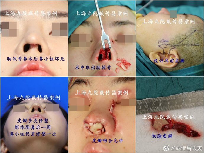 戴傳昌鼻修復(fù)案例
