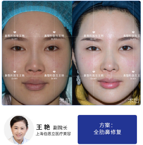 王艷鼻修復(fù)案例