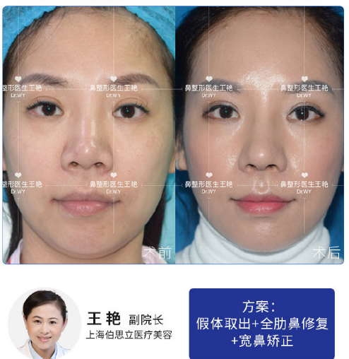 王艷鼻修復(fù)案例
