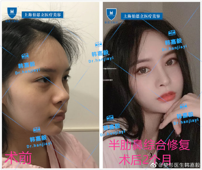 韓嘉毅鼻修復(fù)案例