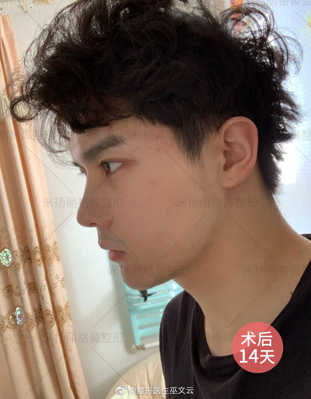 巫文云鼻修復案例