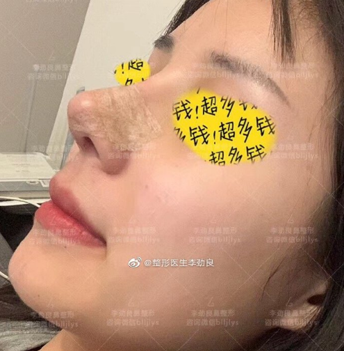 李勁良鼻修復案例