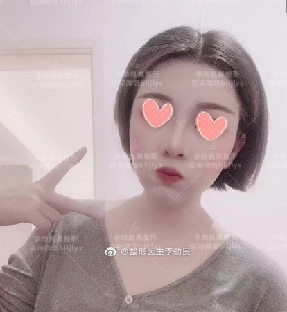 李勁良鼻修復案例