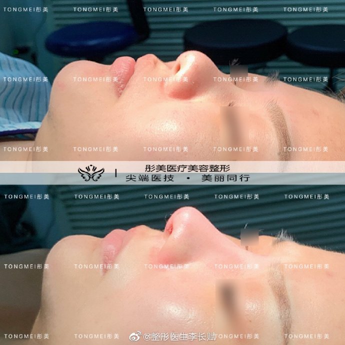 李長賦鼻綜合案例