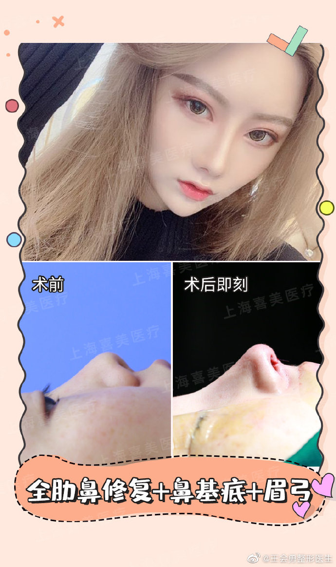 王會勇隆鼻案例