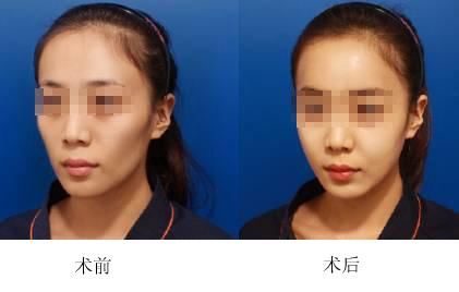 北京脂肪填充專家哪個最出名？